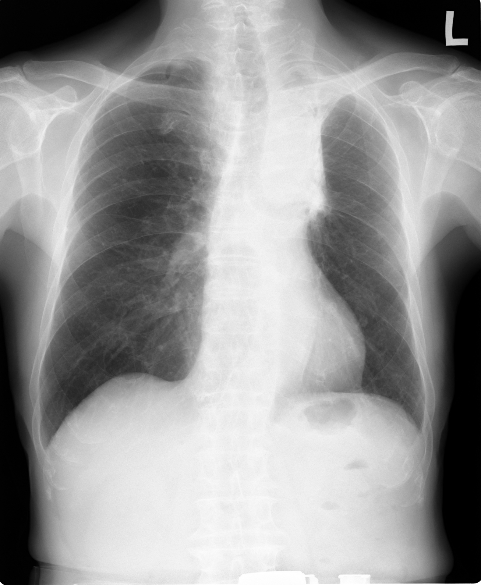 産業医のためのじん肺エックス線写真図譜